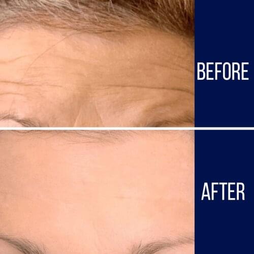 Forehead Facial Patches Wrinkle Resistant Strips Stickers for Men Women