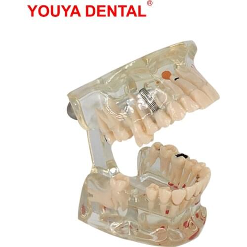 Dental Model With Missing Tooth Transparent Pathology Teeth Model For Studying Teaching Medical Science Dentistry Detal Products