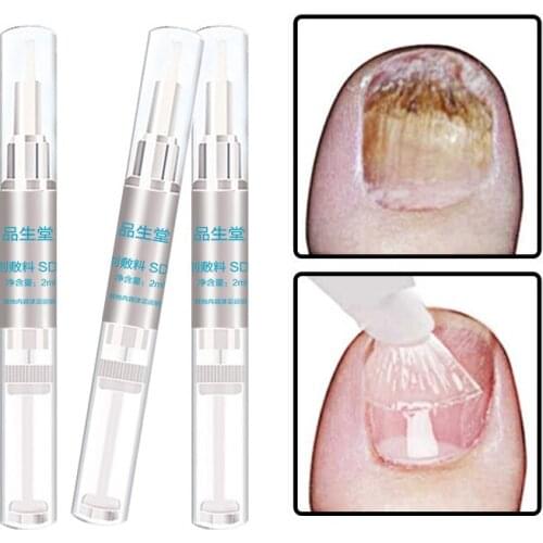 3ML Fungals Nail Treatment Pen Powerful Onychomycosis Paronychia Anti Nail Chinese Herbal Care Repair Serum TSLM2