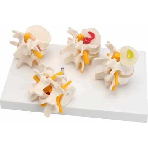4 Part Anatomical Human Lumbar Vertebrae Degenerative Disc Disease Medical Model