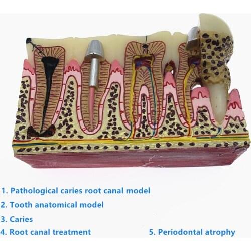 Dental materials Dental Anatomy of dental caries plastic teeth model demonstration