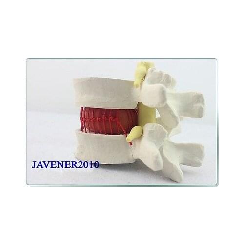 Human Anatomical Lumbar Vertebra Slipped Disc Medical Demonstration Model