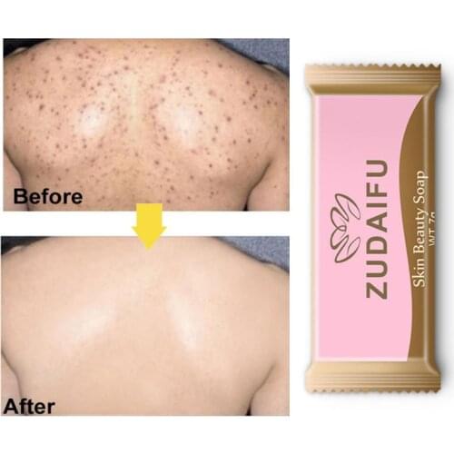 1PC Sulfur Handmade Soap Antibacterial Skin Cleaning Acne Seborrhea Bath Soap Anti-mite Removal Pimple Pore Acne Bath Soap