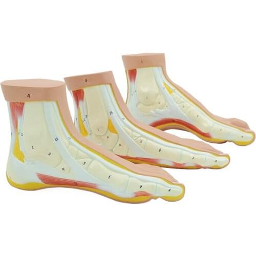 Normal and Abnormal Feet Set of 3 Flat Foot Arched Foot Model Medical Teaching Educational Equipment Foot Skeleton Anatomy
