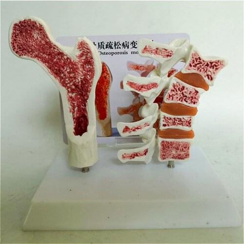Human osteoporosis Comparative model Femoral head Skeletons vertebra anatomical lesions Explanation model