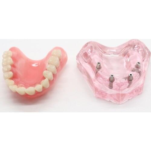 Dental Lab Overdenture Upper Anterior Maxillary 4 Implants Restoration Teeth Model For Dentistry Teaching 1set