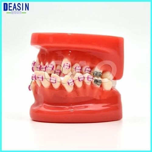 Dentist patient student learning model Orthodontists model With metal brackets Irregular tooth Ortho Metal
