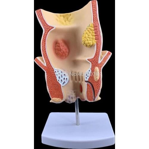 Brand New Anatomical Human Rectum Pathology Lesion Model Hemorrhoids Anus Medical Teaching Supplies