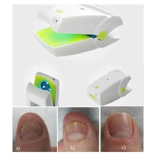Remove Ringworm Infection of Nails Laser Nail Fungus Treatment Device 905nm laser Ringworm leuconychia therapy apparatus