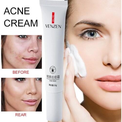 Acne Treatment Cream Fade Repair Acne Marks Moisturizing Repair Shrink Pores Removal Pimple Blackhead Oil Control Skin CareTSLM1
