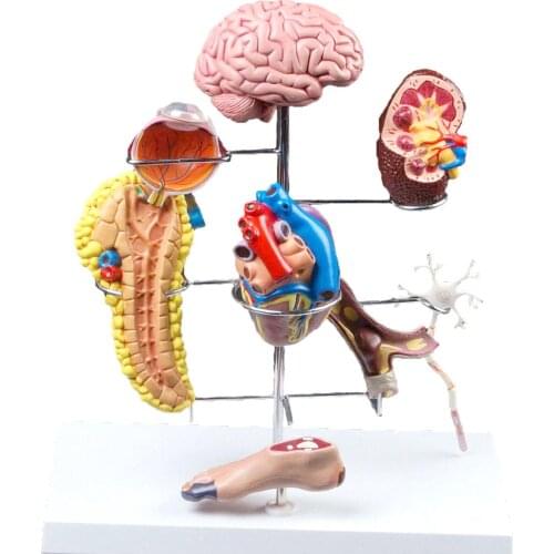 Human Diabetes Model Complications Cerebral Cardiac Pancreas Neuronal Foot Teaching Aid