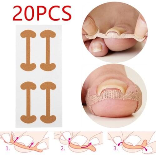 12/20pcs Toenail Patch Ingrown Toenail Correction Pedicure Tool Toe Inlay Nail Corrector Nail Patch Correction Stickers