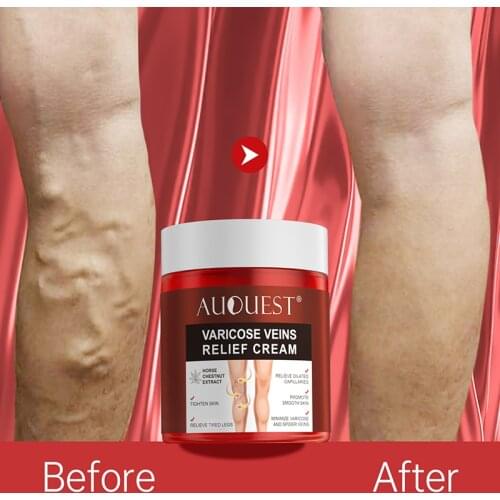 Varicose Veins Treatment Cream Relieve Tired Legs Dilated Capillaries Skin Care Vasculitis Phlebitis Spider Pain Relief ZK30 80g