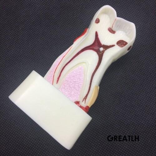 Dentist Dental Study Teach Tooth Model Teeth Disease Model new