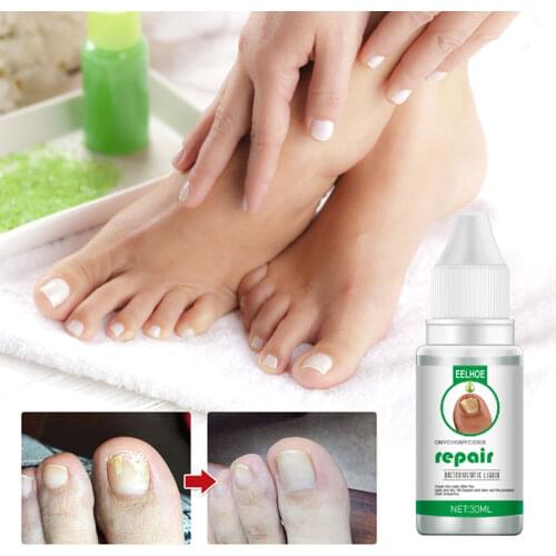 20ML Nail Fungus Treatment Feet Care Fungal Nail Foot Toe Repair Removal Gel Anti Paronychia Onychomycosi Manicure