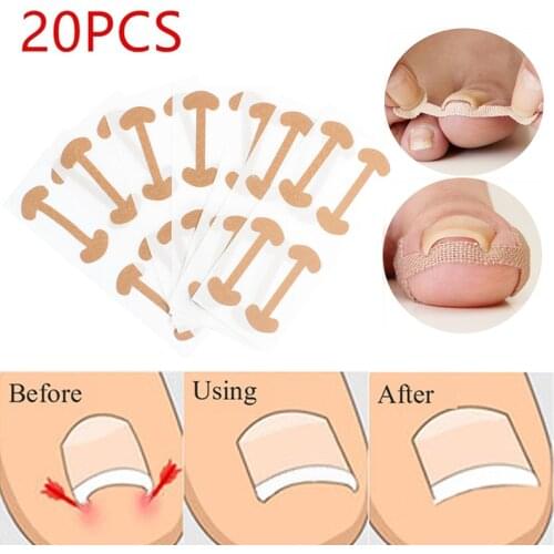 20pcs stickers Ingrown Toenail Paronychia Treatment Toe nail repair Nail Correction Stickers