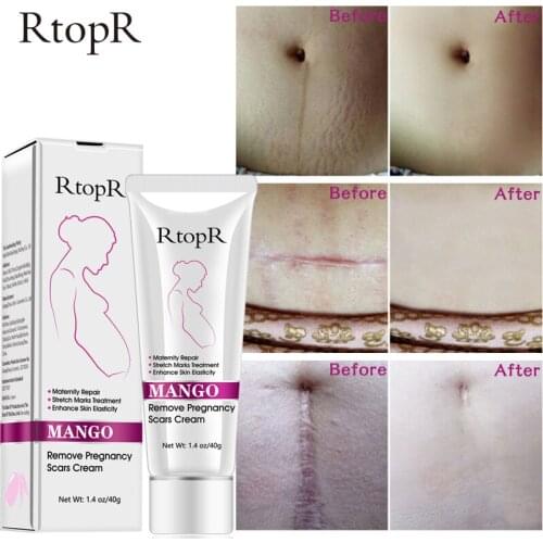 Mango Remove Pregnancy Scars Acne Cream Stretch Marks Treatment Maternity Repair Anti-Aging Anti Winkles Firming Body Creams