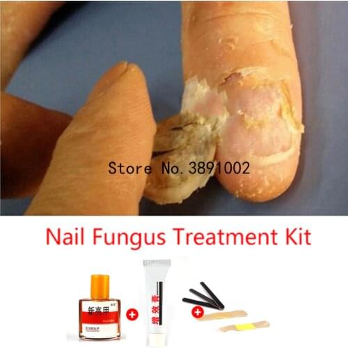 Okeny's Remedies For Nail Fungus
