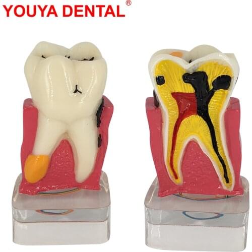 Dental Model Resin 4times Transparent Molar Anatomy Teeth Modeling With Nerves Medical Science Oral Dentist Dentistry Products