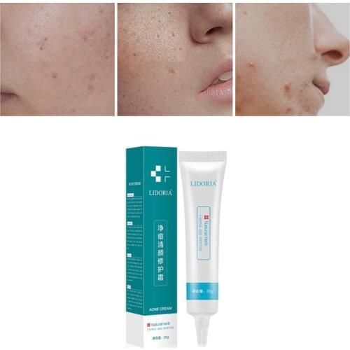 Hot Sale Face Skin Care Acne Treatment Removal Cream Skin Repair Cream 20g Facial Skin Care Dropshipping