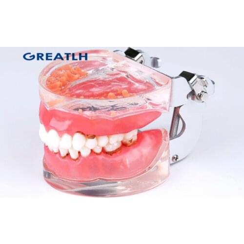 Dental Adult Pathological Periodontal disease 4017# Dental Typodont Teeth Model