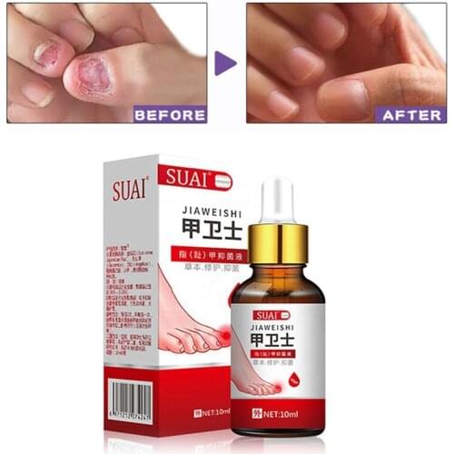 Onychomycosis Essence Nail Fungal Treatment Feet Care Essence Nail Foot Whitening Toe Nail Fungus Removal Gel Anti Infection