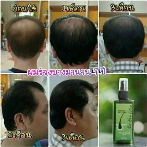 Neo Hair Lotion Hair Loss Treatments Root Nutrients Original 120ml