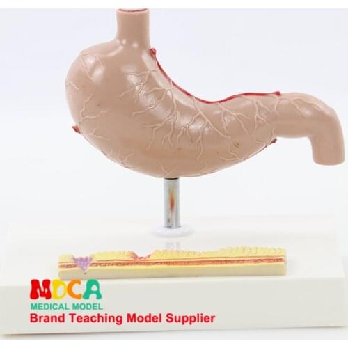 Pathological gastrointestinal model human gastric lesions teaching aids digestive system medicine teaching MCW008