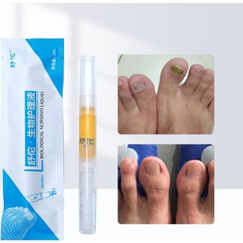 Nail Repair Liquid Painless Nail Fungus Removal Anti Onychomycosis Paronychia Feet Care Treatment Anti Fungal Toe Repair Liquid