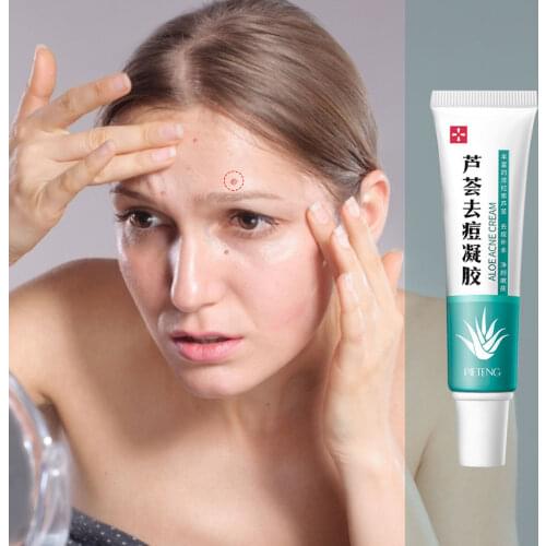 Effective Acne Removal Cream Acne Treatment Fade Acne Spots Oil Control Shrink Pores Whitening Moisturizing Acne Cream Skin Care