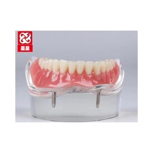 Micro planting Repair model Dental Teaching Patient communication free shipping