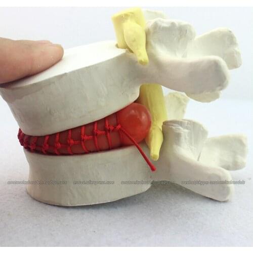CMAM/12392 Slipped disk,Disc herniation, 1.5x, Medical Backbone Anatomical Human Model