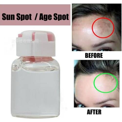 Sun Spot, Age Spot, Brown Spot, Dark Spot Remover/Treatment, Corrector NO SCAM