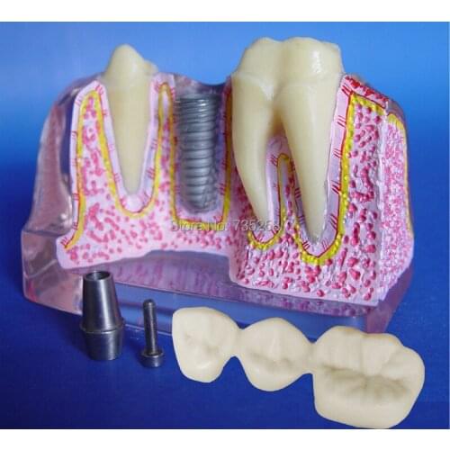 Four Times The Magnification Transparent Dental Implant Model,Tooth Model,Dental Implant Practice Model
