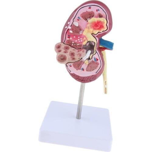Human Kidney Anatomical Model 2-Sided, Normal And With Pathologies, Perfect for displaying and explaining to patients/ students