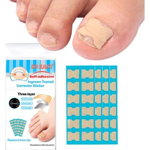 72PCS Pedicure Tools Ingrown Toenail Physical Straightening Corrector Elastic Correction Patch Correction Patch Sticker Clip