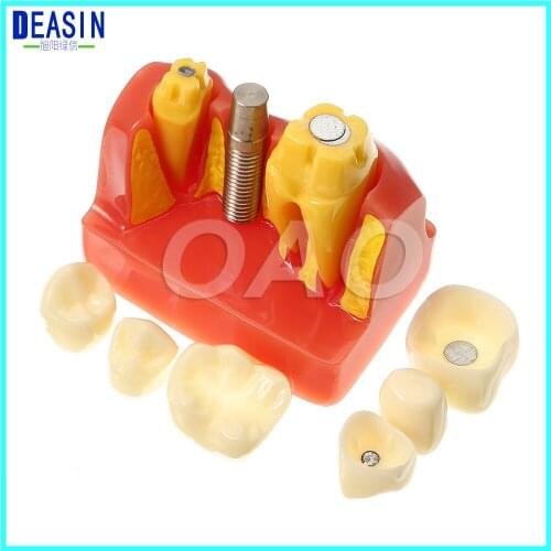 CROWN BRIDGE DEMOSTRATATION TEETH TOOH TYPODONT DENTOFORM MACRO IMPLANT TEETH MODEL