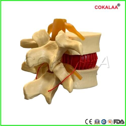 Human lumbar disc herniation demonstration model of lumbar vertebral spine model