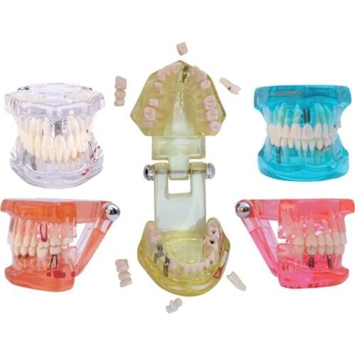 C15 Dental Implant Disease Teeth Human Medical Orthodontic Model Dental Implant Teeth Model with Restoration and Pathologies