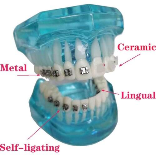 1 Piece Dental Teeth Model Orthodontic 4-type Brackets Contrast Metal/Ceramic/Lingual/Self-ligating