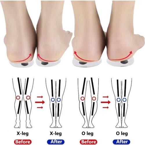 1 Pair Magnet Silicon Orthopedic Insoles Foot Care Tool For Men Women Health Care O/X Type Leg Knee Varus Correction Heel Pad
