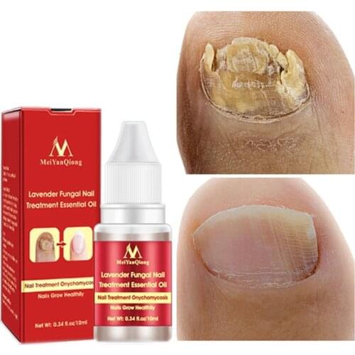 10ML Fungal Nail Treatment Serum Onychomycosis Paronychia Anti-Fungal Nail Infection Herbal Toe Fungus Foot Repair Essence Care