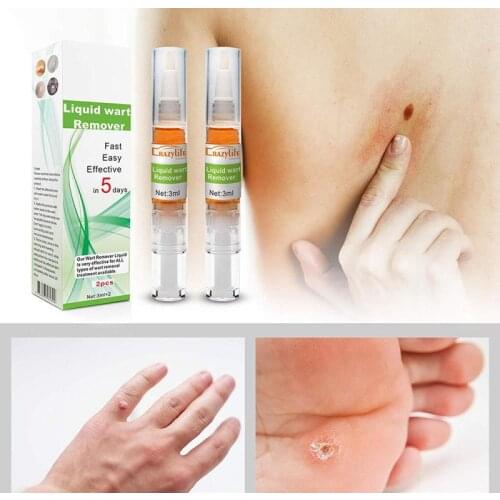 Wart Remove Liquid Pen Crazylife Wark Pen Acne Treatment Toe Foot Face Hand Remove Moles Remover Mole Potion Repair Fluid TXTB1