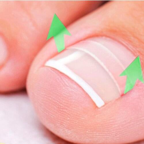 NEW 10pcs/box Ingrown Toe Nail Correction Sticker Patch Paronychia Correction File Acronyx Wire Corrector Foot Care Treatment