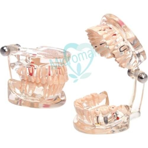 1pcs Dental Implant Teaching Model With Restoration Bridge Tooth Dentist For Dental Disease Teaching Study