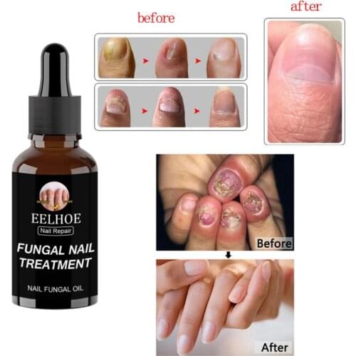 50ml Fungus Remedy Nail Fungal Treatments Feet Care Essences From Nail Fungus Foot Toe Anti Infective Paronychia Onychomycosis