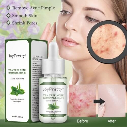 Tea Tree Skin Serum Acne Removal Serum Natural Safe Face Serum for Fading Acne Marks Spots Skin Care Serum for All Skins