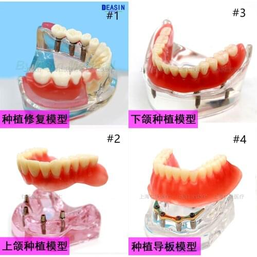 Dental implant DemonstrationTeeth Model for teaching and dentist student learning Deasin
