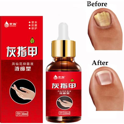 Nail Fungal Treatment Feet Care Essence Nail Foot Whitening Toe Nail Fungus Removal Gel Anti Infection Paronychia Onychomycosis