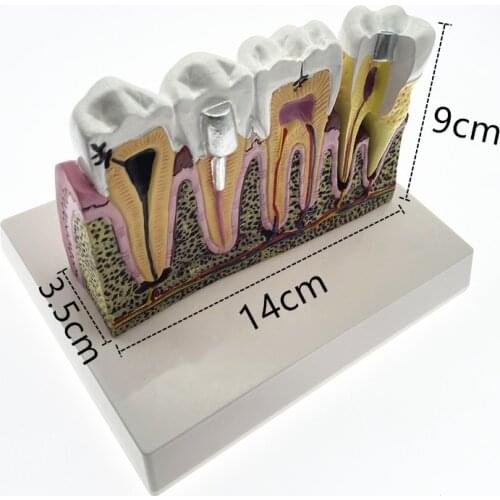 Dental caries anatomy comprehensive pathology tooth nerve tooth model for oral teaching teeth model
